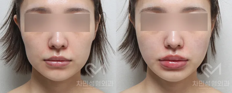 측면