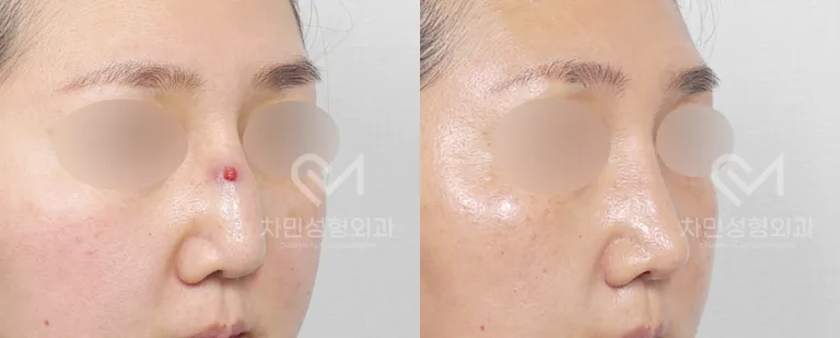 측면