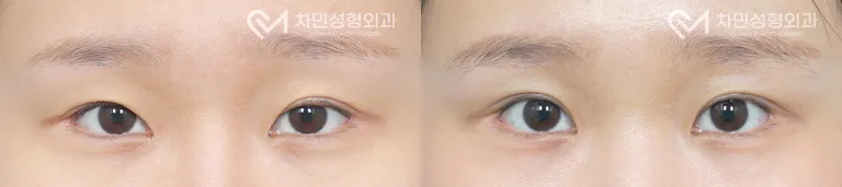 측면