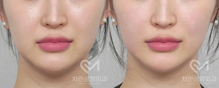 측면