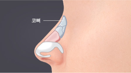 코뼈 정복술