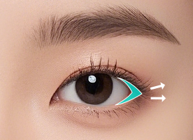 뒤트임
