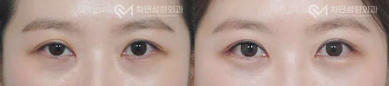 측면