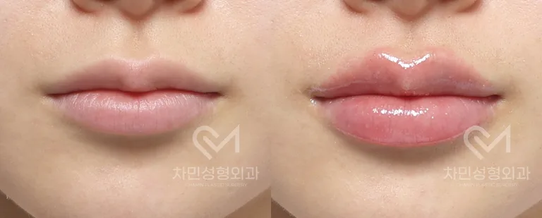 측면