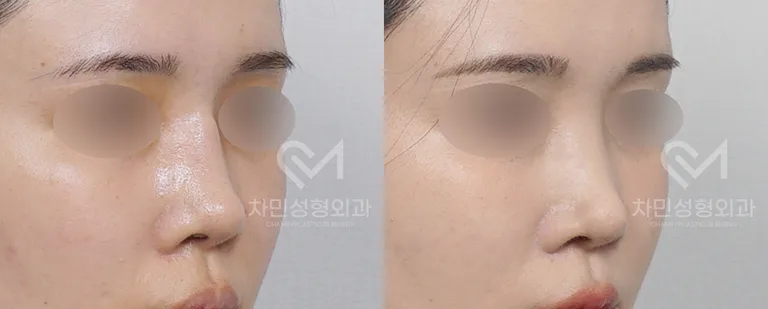 측면