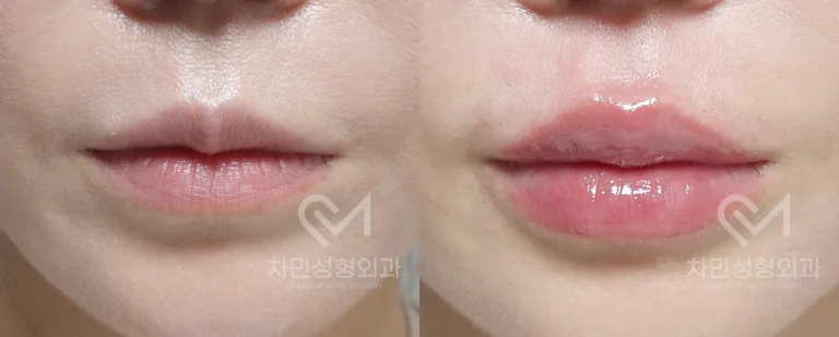 측면