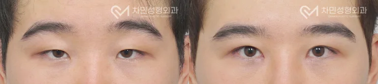 측면