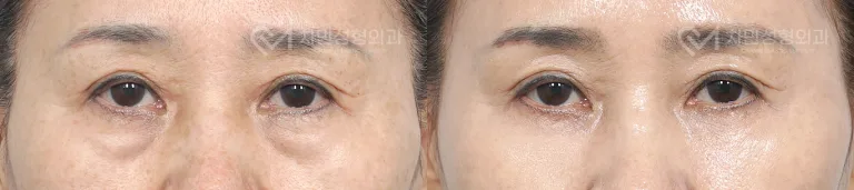 측면