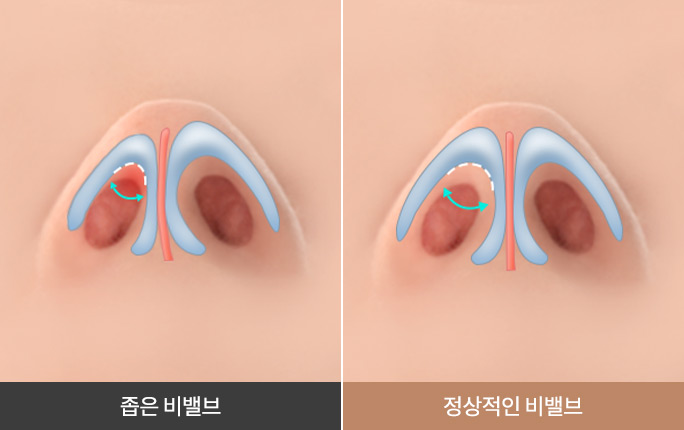 비밸브협착증