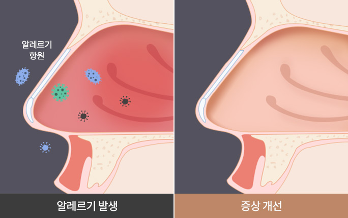 알레르기비염