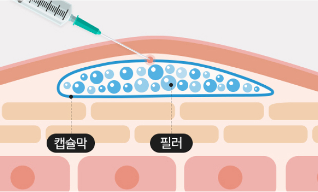 잘못된 히알라제 시술