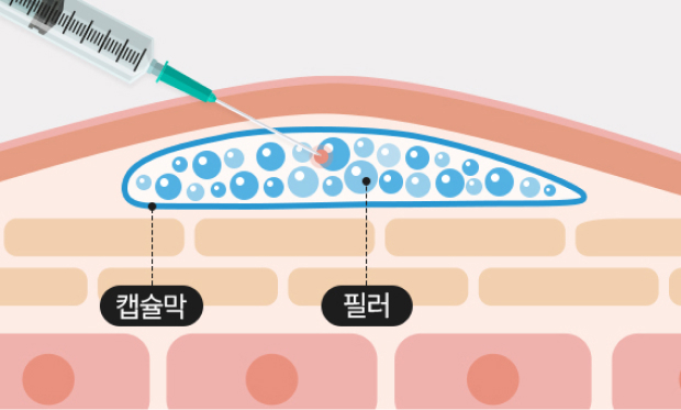 차민 히알라제 시술 방법