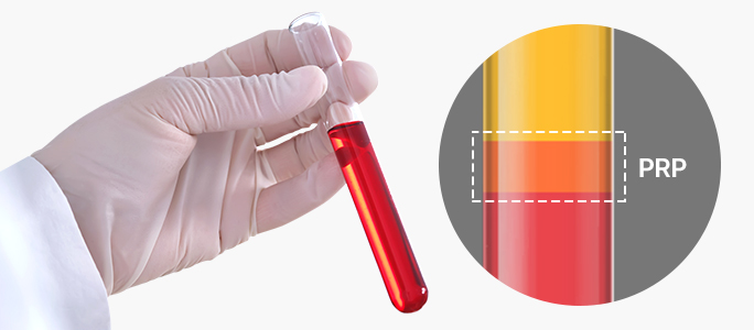 PRP혼합