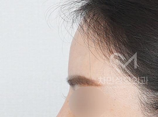 전후사진