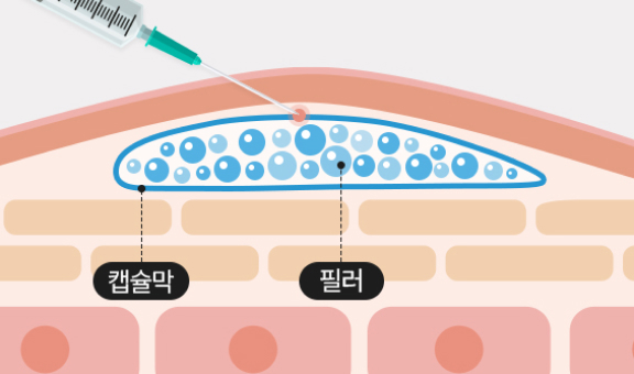 잘못된 히알라제 시술