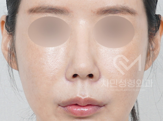 전후사진