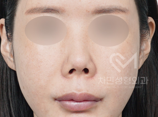 전후사진
