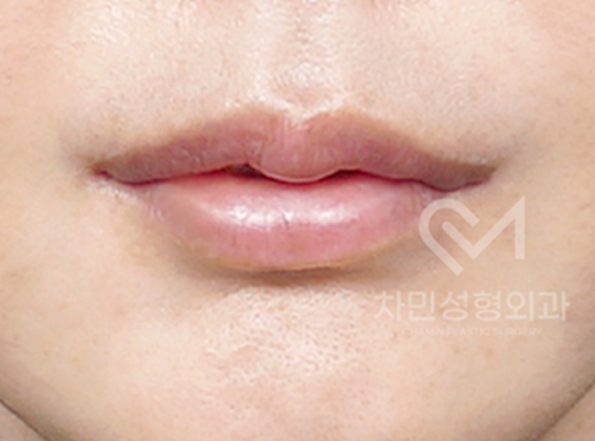 전후사진
